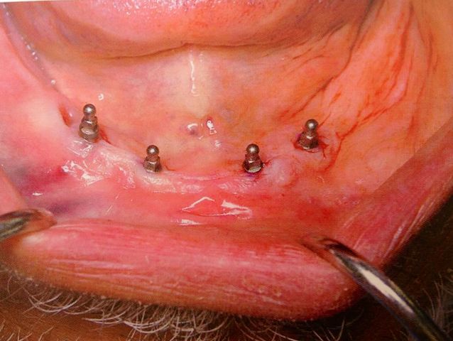 Colocación de 4 mini implantes