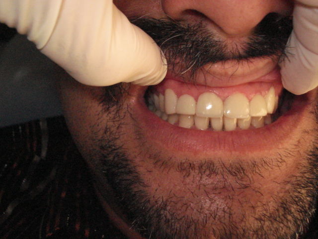 CORRECCION DE POSICION Y COLOR DESPUES