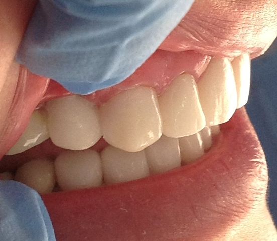 Premolar ya colocado
