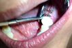Zona de primer molar, con 2 mini implantes