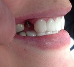 Perdida de premolar y colocación de mini implante